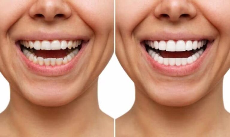 Dental Veneers near Me: Your Perfect Smile Solution