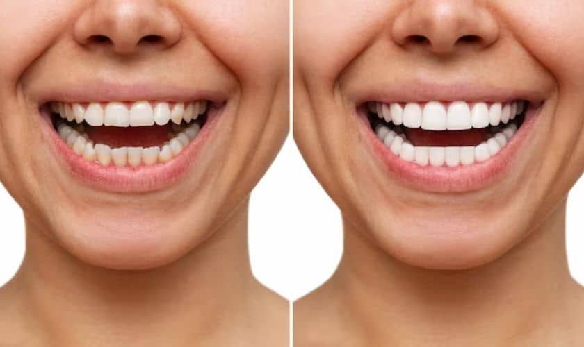 Dental Veneers near Me